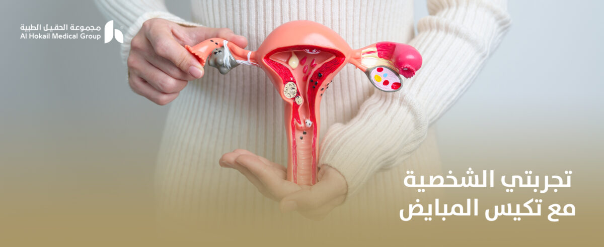 تجربتي-الشخصية-مع-تكيس-المبايض-1200x492.jpg