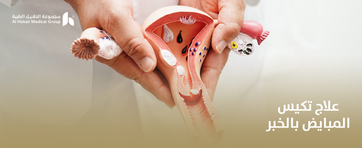 علاج-تكيس-المبايض-بالخبر-1200x492.jpg
