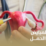 أعراض تكيس المبايض وتأثيرها على الحمل
