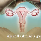علاج ضعف التبويض بالعلاجات الحديثة