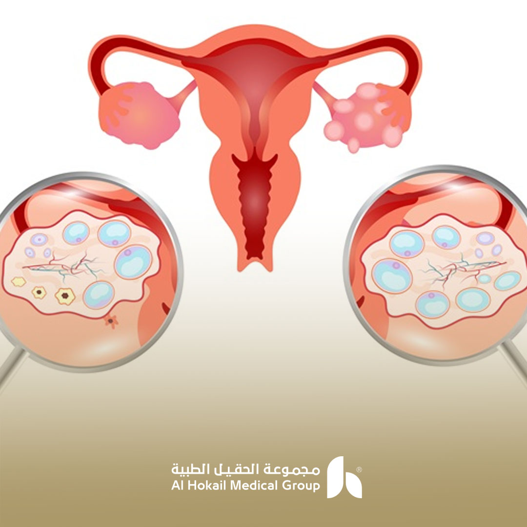 علاج تكيس المبايض؟ وهل يؤثر على نجاح الحمل؟ 1 علاج تكيس المبايض؟ وهل يؤثر على نجاح الحمل؟