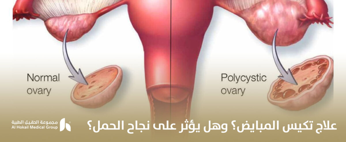 علاج-تكيس-المبايض؟-وهل-يؤثر-على-نجاح-الحمل؟-1200x492.jpg