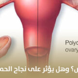 علاج تكيس المبايض؟ وهل يؤثر على نجاح الحمل؟
